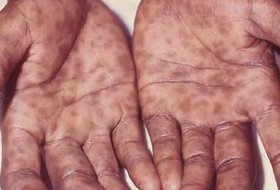 frengi-syphilis-hands