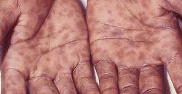 frengi-syphilis-hands